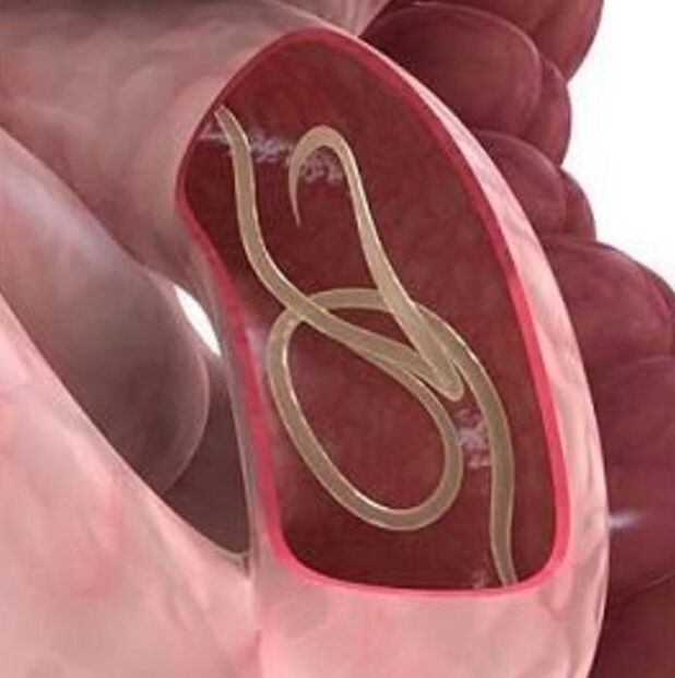 Mga palatandaan ng mga bulate sa isang tao sa gastrointestinal tract